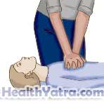 Cardiopulmonary Resuscitation for Children Age 1 to Early Teens