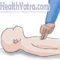 Cardiopulmonary Resuscitation for Infants 1