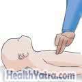 Cardiopulmonary Resuscitation for Infants1