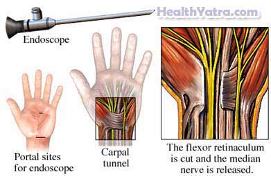 Carpal Tunnel Release 1