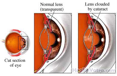 Cataract Removal 1