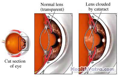 Cataract Removal