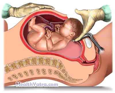 Cesarean Birth 1