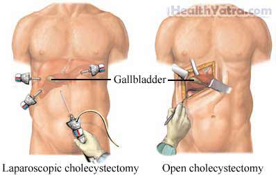 Cholecystectomy Laparoscopic Surgery