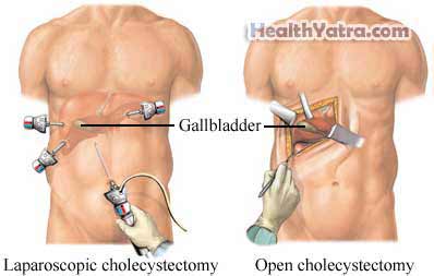 Cholecystectomy Open Surgery