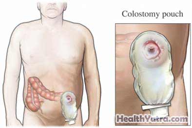 Colectomy Open Surgery1