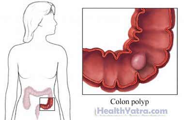 Colon PolypectomyColon polyp removal