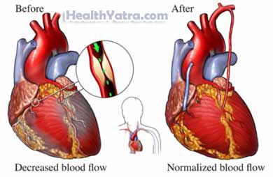Coronary Artery Bypass Grafting 2