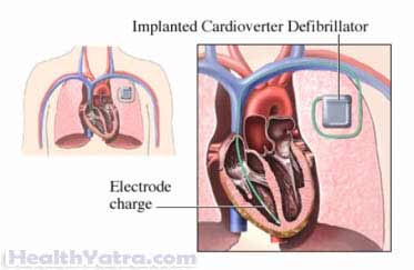Defibrillator Implantation