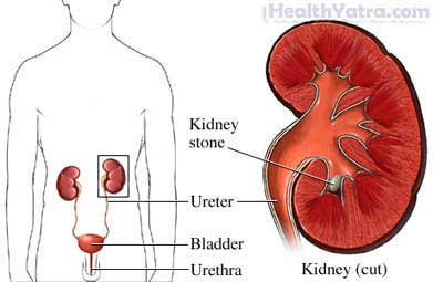 Extracorporeal Shock Wave Lithotripsy for Kidney Stones 1