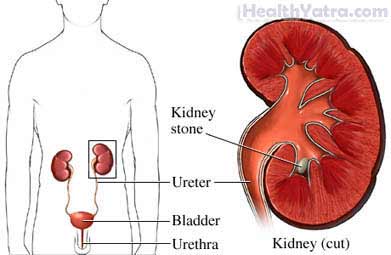 Extracorporeal Shock Wave Lithotripsy for Kidney Stones