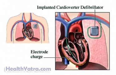 Implanted Cardioverter Defibrillator