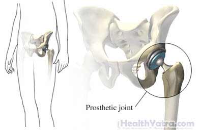 Left Total Hip Replacement