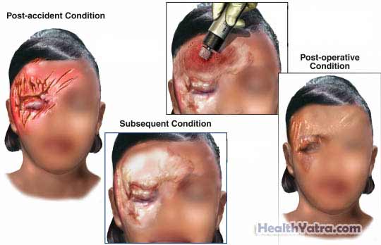 Multiple Facial Injuries with Surgical Dermabrasion