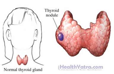 Needle Biopsy Thyroid