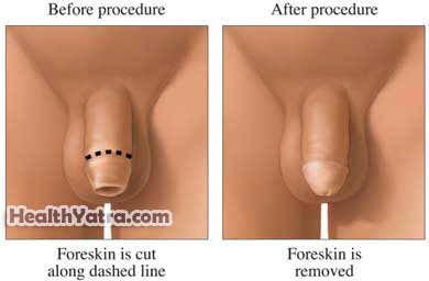 Newborn Circumcision