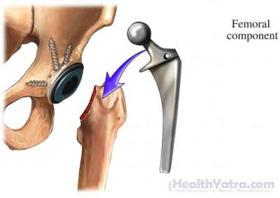 Placement of Prosthesis