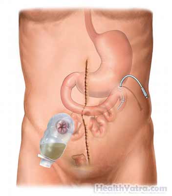 Pouch Created During Ileostomy