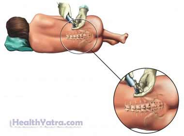 Spinal Corticosteroid Injection