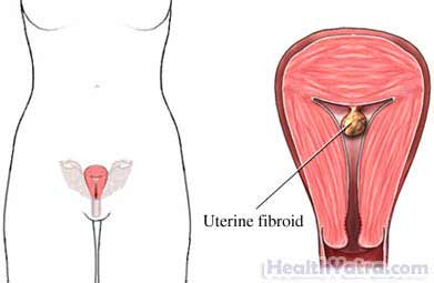 Uterine Fibroid