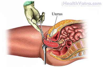 योनि गर्भाशय-उच्छेदन