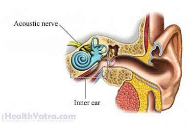 إزالة الورم العصبي السمعي