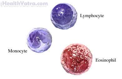 তীব্র lymphoblastic লিউকেমিয়া