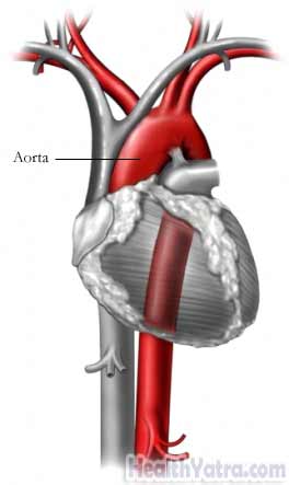 Aortic Coarctation Adult