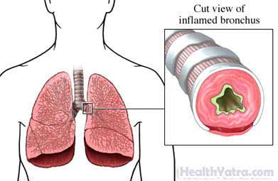 Asthma Adult