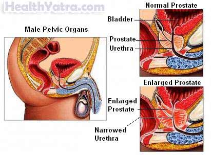 ফলপ্রদ prostatic hyperplasia