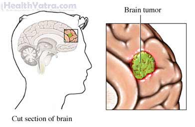 Brain Tumor and Brain Cancer Adult