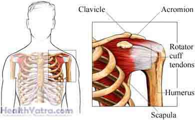 कंधे का कैल्सीफिक टेंडोनाइटिस