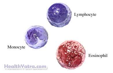 Chronic Lymphocytic Leukemia 2
