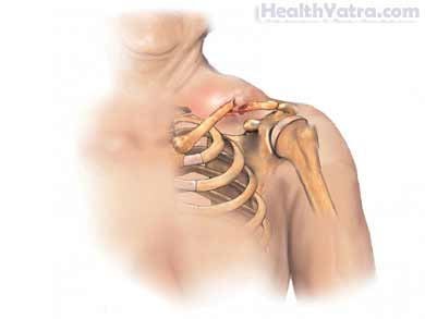 Clavicle Fracture, Causes, Symptoms, and Cost Surgery Treatment in India