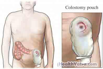 Colectomy Laparoscopic Surgery1