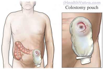 Colectomy Laparoscopic Surgery2