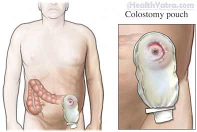 Colectomy Open Surgery2