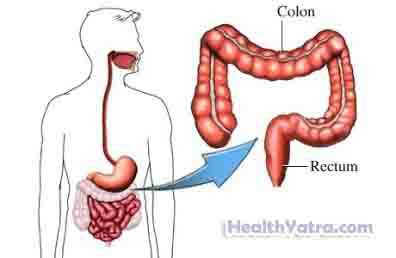Colectomy Open SurgeryPartial colectomy