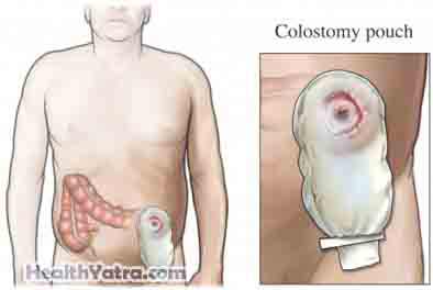 Colectomy Open SurgeryPartial colectomy1