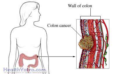 Colon Cancer