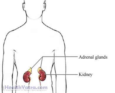Congenital Adrenal Hyperplasia