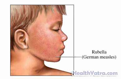 Congenital Rubella Syndrome