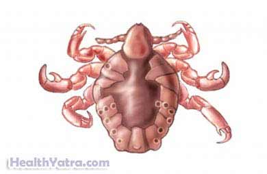 Crab Lice Definition, Causes, Symptoms, Complications and ...