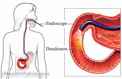 Esophageal Variceal Injection