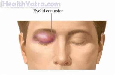Eye Contusion