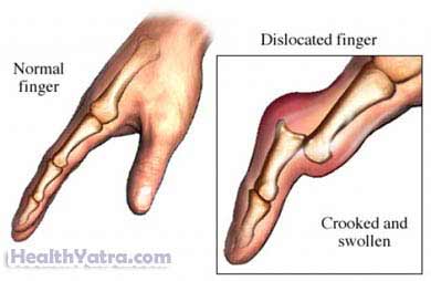 Finger Dislocation