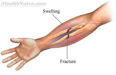 Forearm Fracture