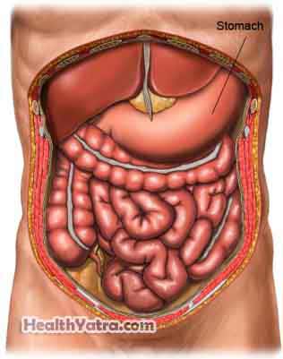 Gastrectomy1