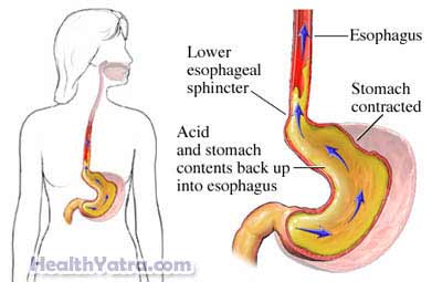 Gastroesophageal Reflux Disease Child Definition Causes Symptoms health yatra
