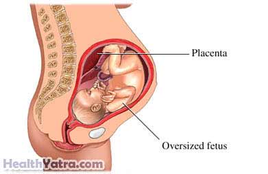 गर्भावस्थाजन्य मधुमेह